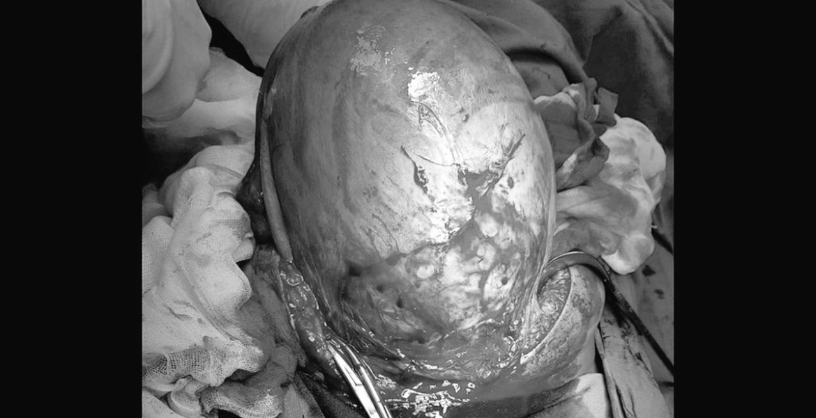 extracción de útero con bebé