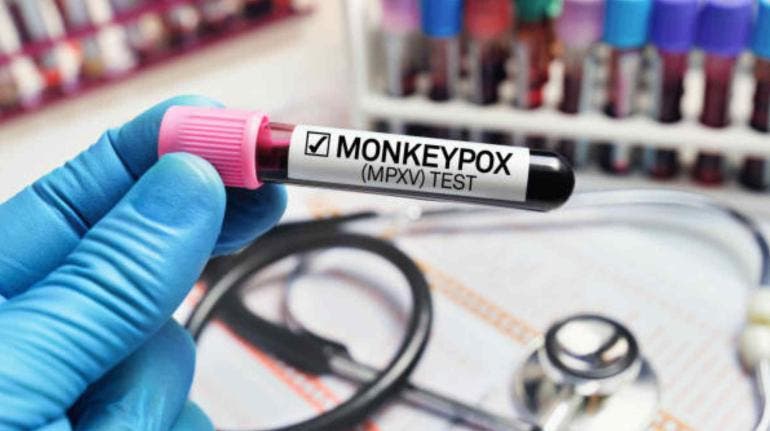 OMS advierte sobre transmisión de viruela símica; 26 países reportan casos 