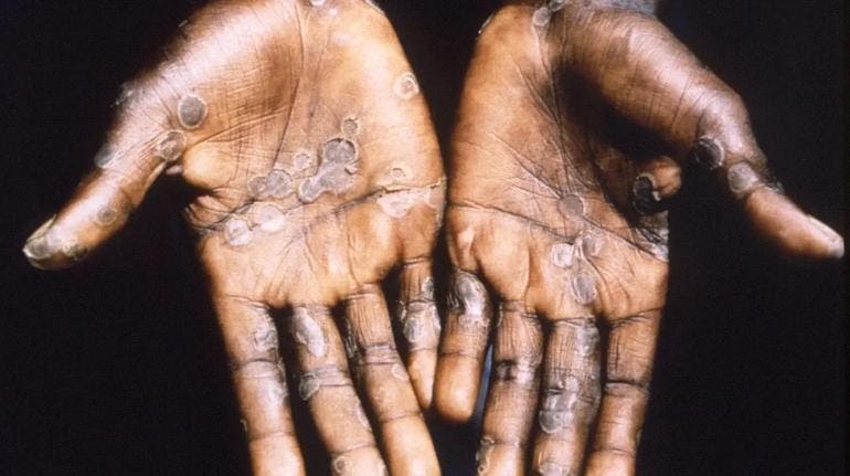 Ssa mpox cuatro nuevos casos