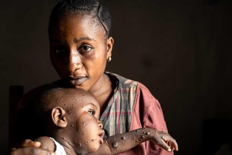 Así afecta la piel el mpox o viruela del mono que suma 643 muertes en África (EFE)
