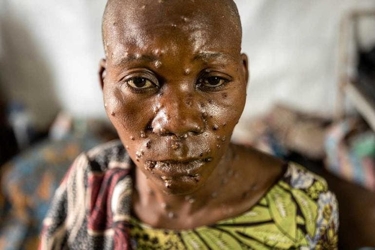 Así afecta la piel el mpox o viruela del mono que suma 643 muertes en África (EFE)