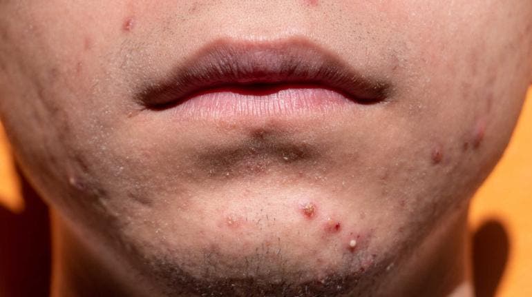 acne Mexico salud