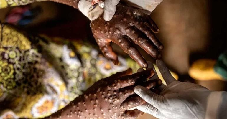 Mpox África