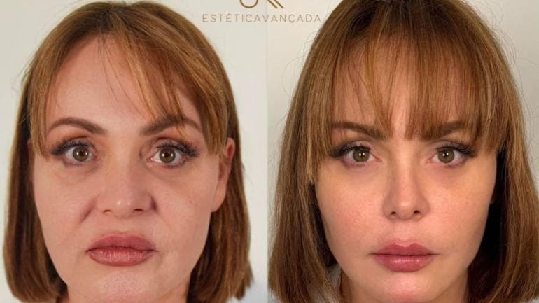 De polémica en reality a rejuvenecimiento total: Gaby Spanic muestra su nuevo rostro