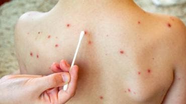 Ssa sarampion cuatro casos confirmados