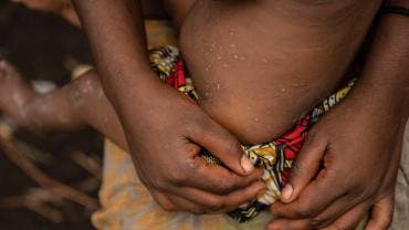 Mpox - viruela del mono