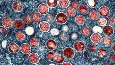 Pakistán confirma el primer caso de viruela del mono en Asia