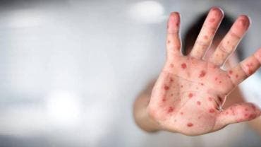 Alemania detecta primer caso nueva variante mpox