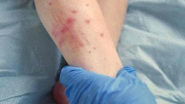 Suben a 421 los casos de sarampión en México