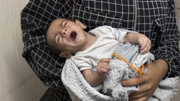 un tercio ninos Gaza sufren desnutricion moriran ONU