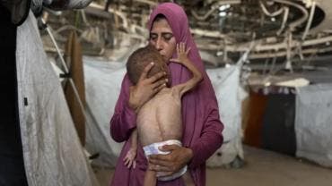 Desnutrición infantil 