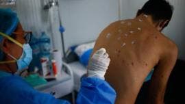 mpox viruela mono 49 casos Mexico