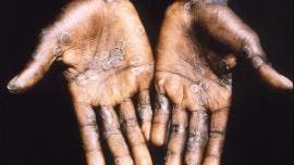 Ssa mpox cuatro nuevos casos