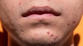 acne Mexico salud