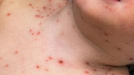 se intensifica brote sarampion Mexico.jpg