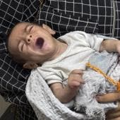 un tercio ninos Gaza sufren desnutricion moriran ONU