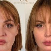 De polémica en reality a rejuvenecimiento total: Gaby Spanic muestra su nuevo rostro