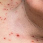 se intensifica brote sarampion Mexico.jpg