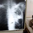 Tuberculosis