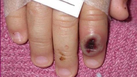 Mexico segundo sitio viruela simica America tres muertes.jpg