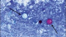 Brote de Cyclospora en EE. UU.: Síntomas, estados afectados y prevención