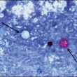 Brote de Cyclospora en EE. UU.: Síntomas, estados afectados y prevención